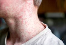 How to protect against measles