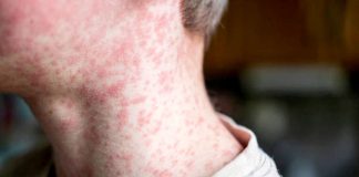 How to protect against measles