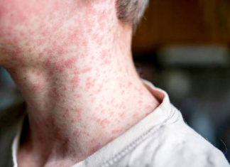 How to protect against measles