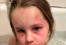 Scratching to fund eczema medicine for children