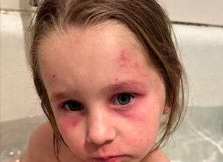 Scratching to fund eczema medicine for children